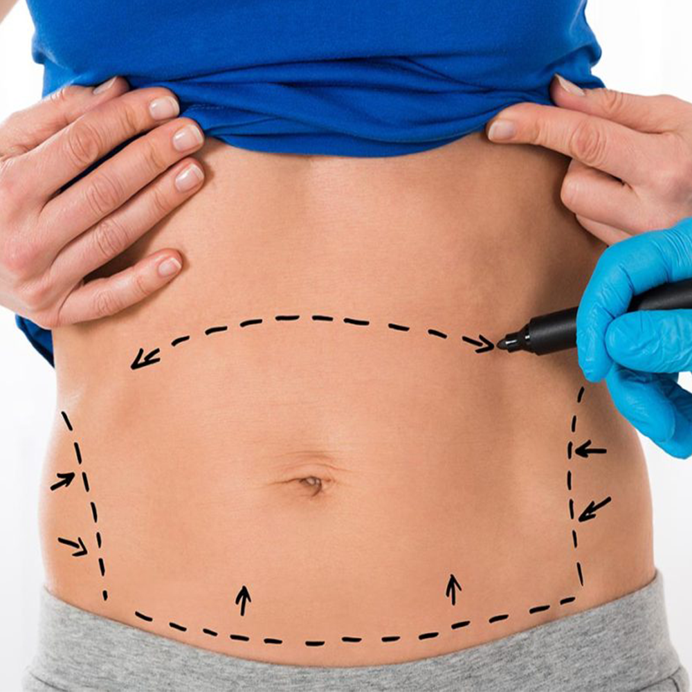 tummy tuck surgery