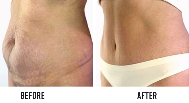 before and after tummy tuck surgery