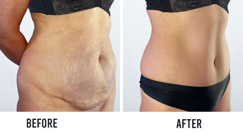 before and after tummy tuck surgery